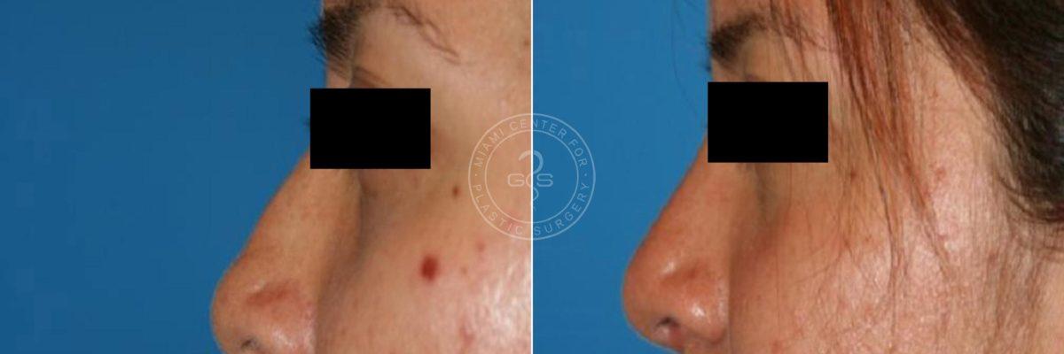 Miami Center for Plastic Surgery rhinoplasty result — Miami, FL
