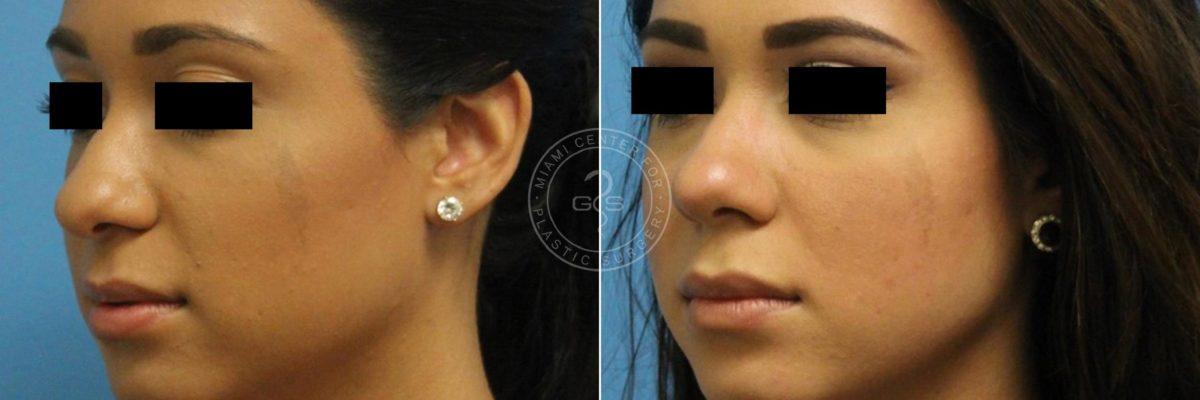 Miami Center for Plastic Surgery rhinoplasty result — Miami, FL
