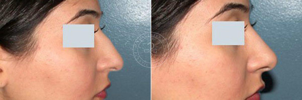 Miami Center for Plastic Surgery rhinoplasty result — Miami, FL