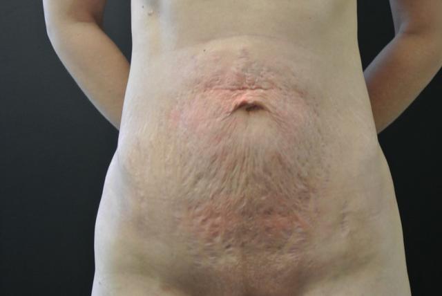 Mini Tummy Tuck before at June S. Chen, M.D., P.C. in Salt Lake City, UT
