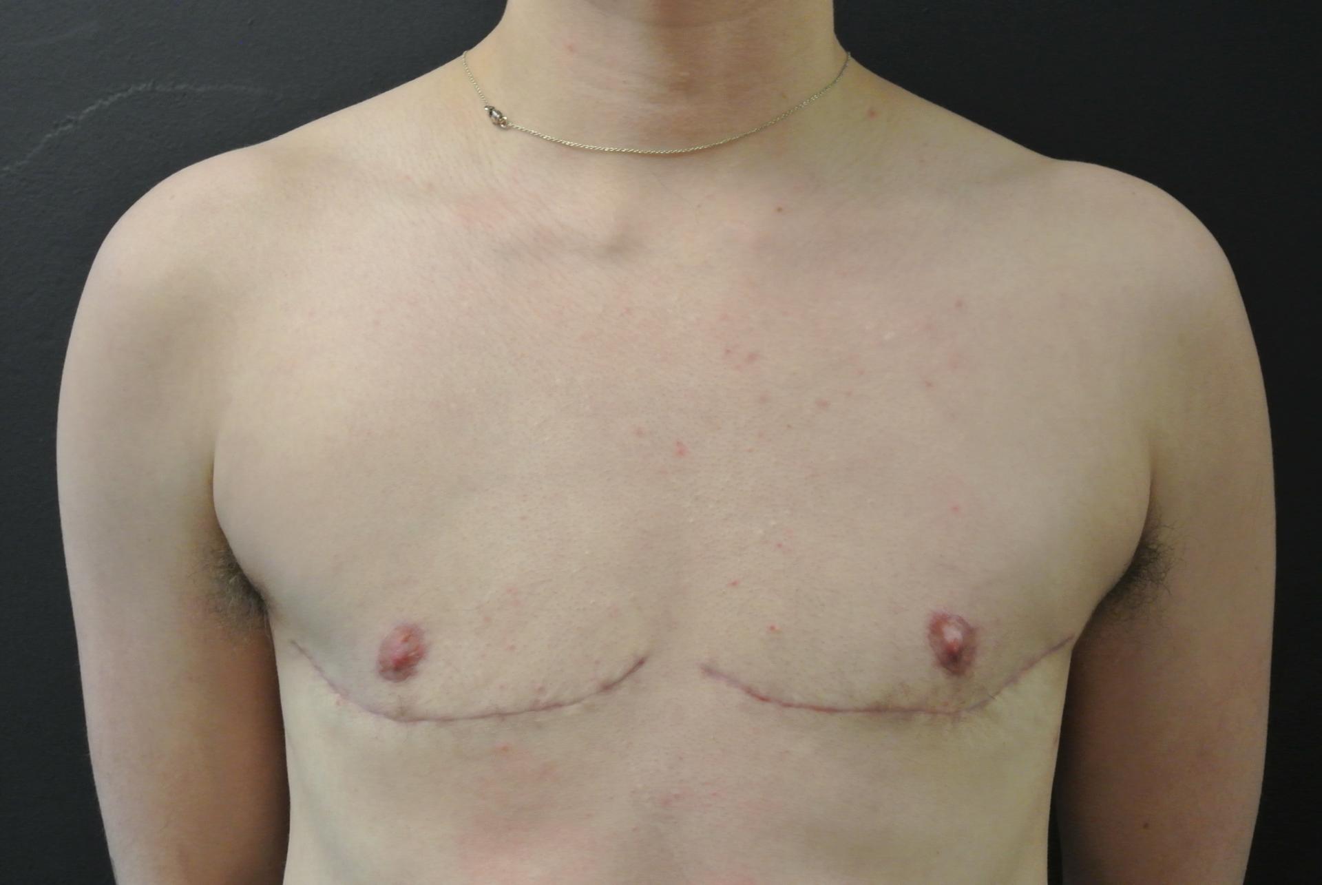 June S. Chen, M.D., P.C. gender affirming top surgery after — Salt Lake City, UT