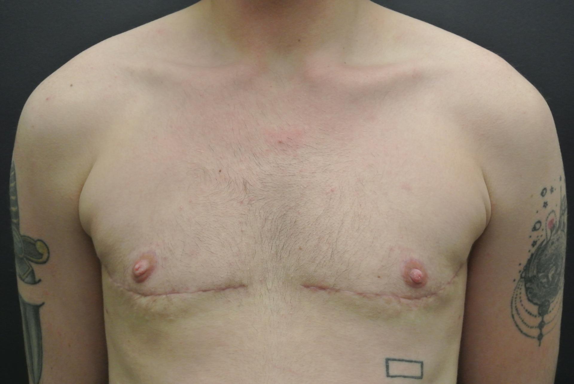 June S. Chen, M.D., P.C. gender affirming top surgery after — Salt Lake City, UT