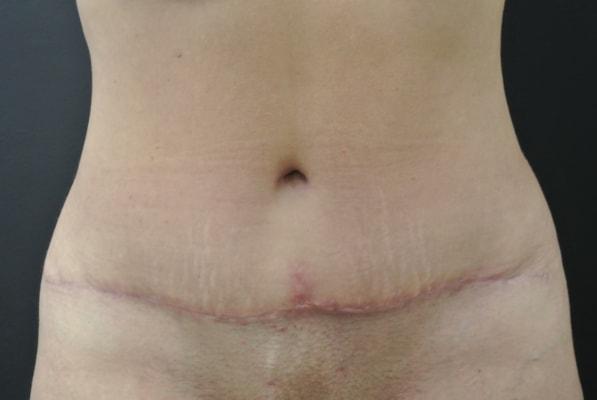 June S. Chen, M.D., P.C. tummy tuck after — Salt Lake City, UT