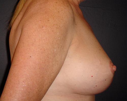June S. Chen, M.D., P.C. breast reduction after — Salt Lake City, UT