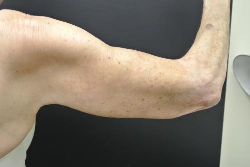 Arm Lift after at June S. Chen, M.D., P.C. in Salt Lake City, UT