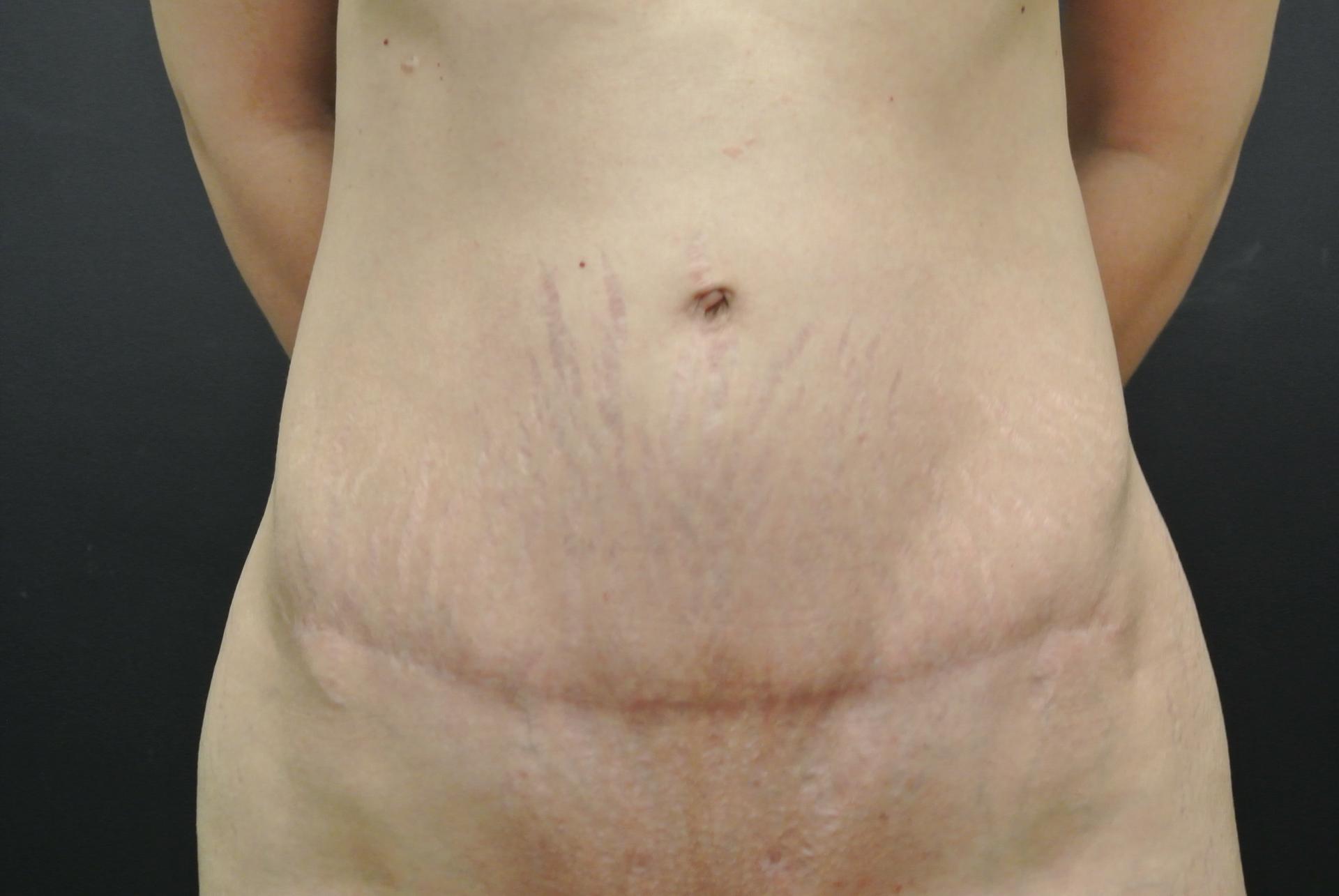 June S. Chen, M.D., P.C. tummy tuck after — Salt Lake City, UT