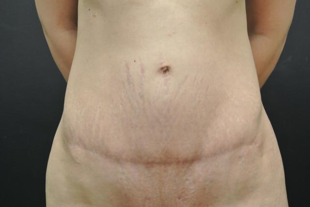 Mini Tummy Tuck after at June S. Chen, M.D., P.C. in Salt Lake City, UT
