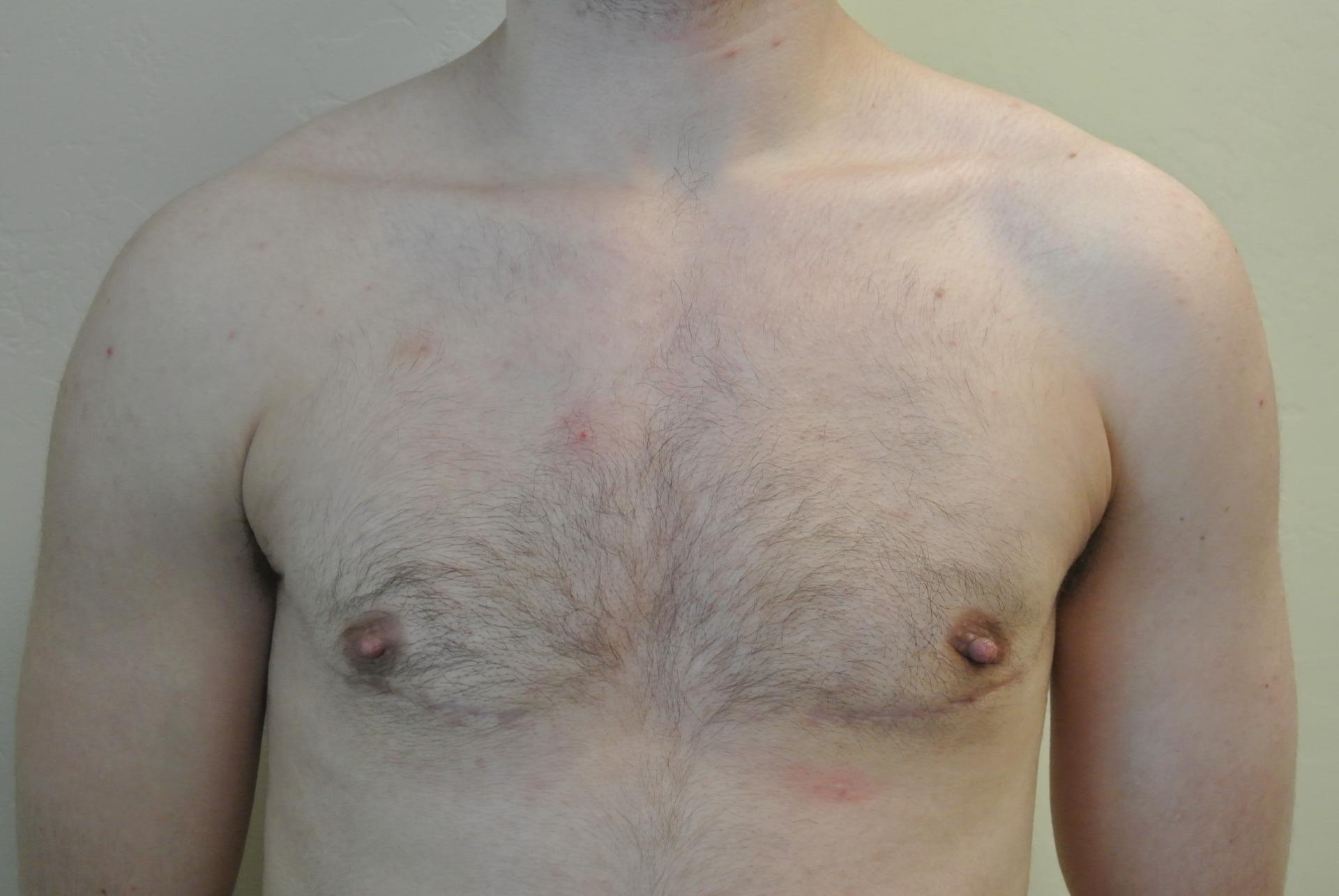 June S. Chen, M.D., P.C. gender affirming top surgery after — Salt Lake City, UT