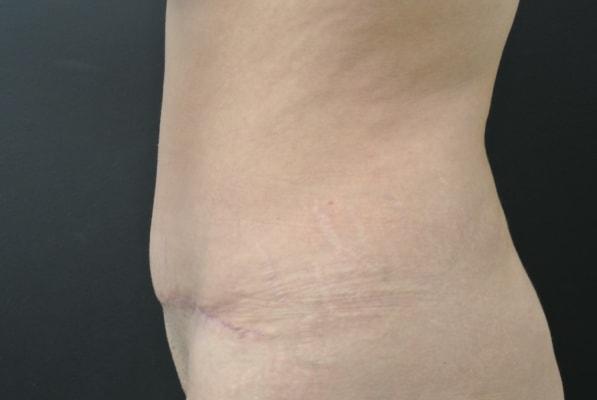 June S. Chen, M.D., P.C. tummy tuck after — Salt Lake City, UT