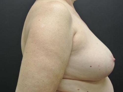 June S. Chen, M.D., P.C. breast reduction after — Salt Lake City, UT