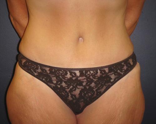 June S. Chen, M.D., P.C. tummy tuck after — Salt Lake City, UT