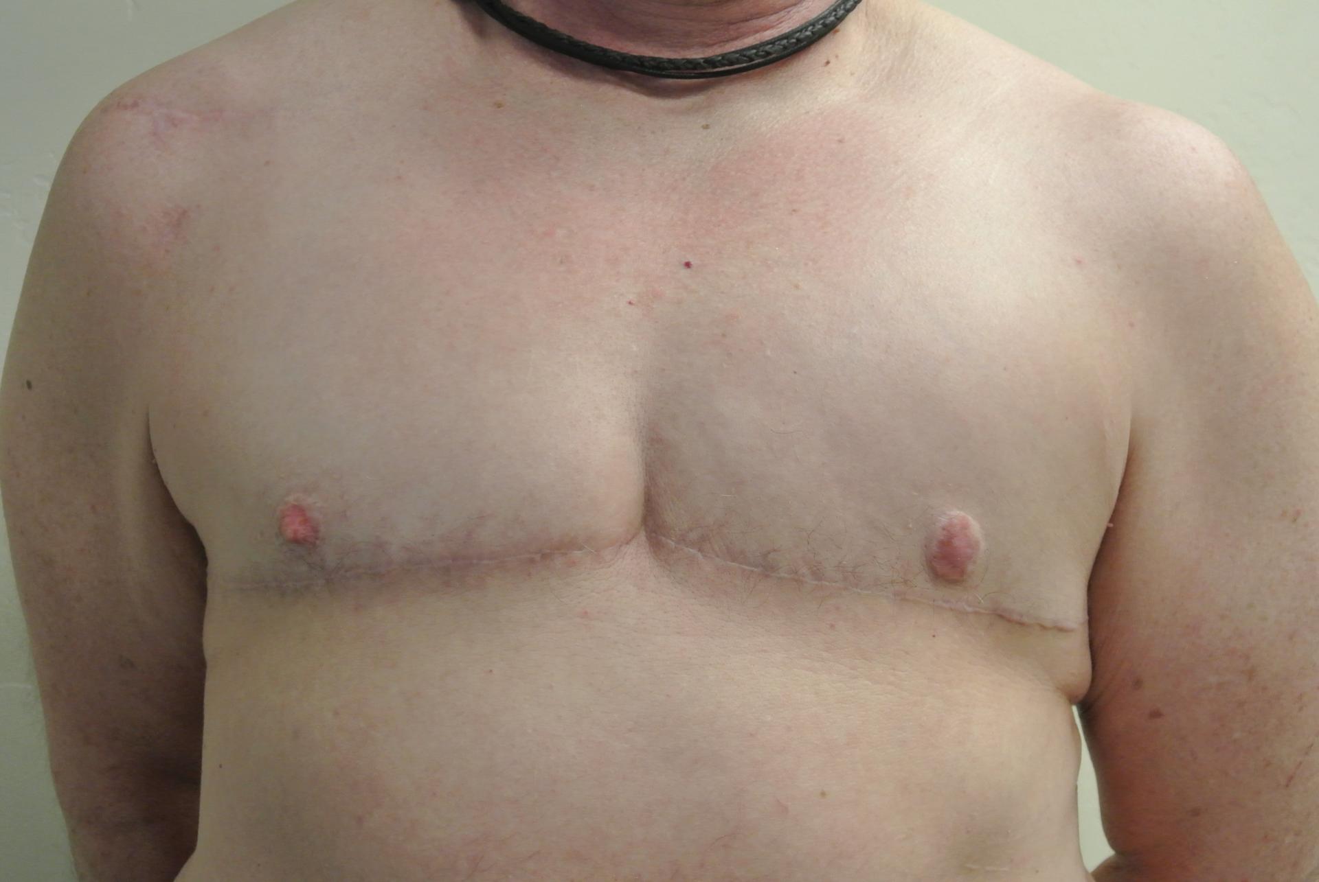 June S. Chen, M.D., P.C. gender affirming top surgery after — Salt Lake City, UT