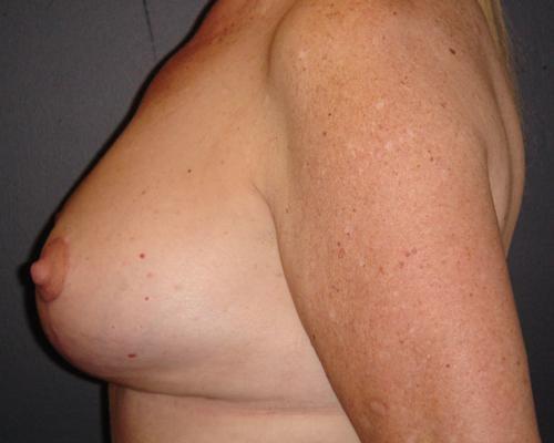 June S. Chen, M.D., P.C. breast reduction after — Salt Lake City, UT