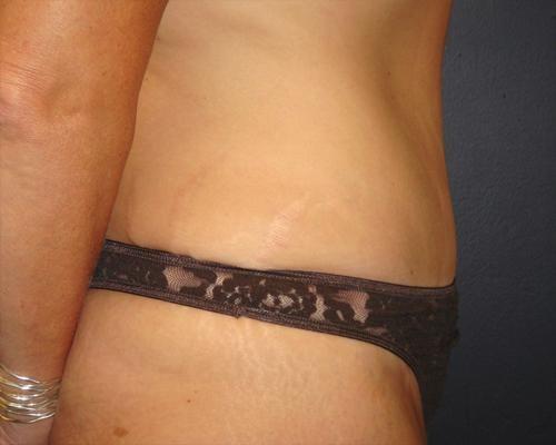 June S. Chen, M.D., P.C. tummy tuck after — Salt Lake City, UT