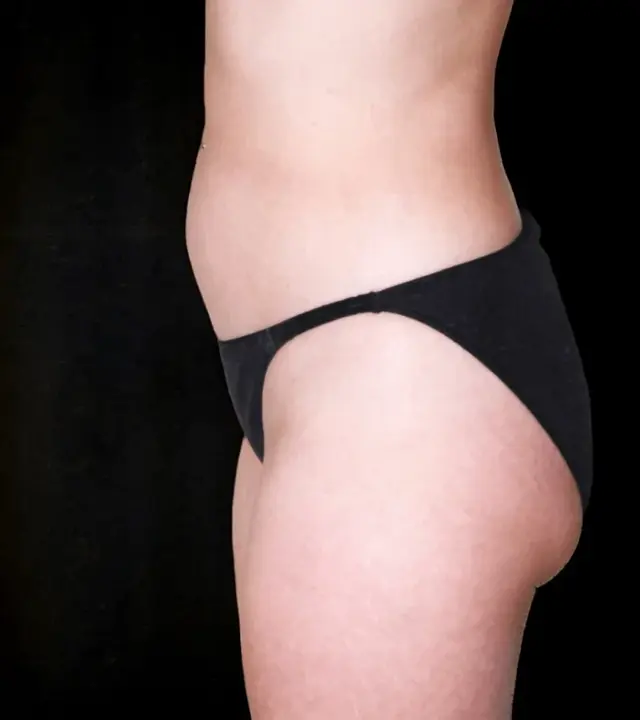 Liposuction before at Aesthetic Surgery Center: Michael R. Macdonald, M.D. in San Francisco, CA