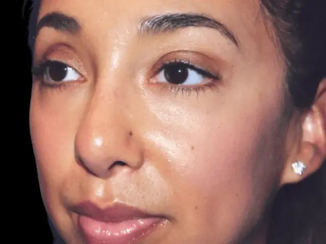 Functional Rhinoplasty after at Aesthetic Surgery Center: Michael R. Macdonald, M.D. in San Francisco, CA