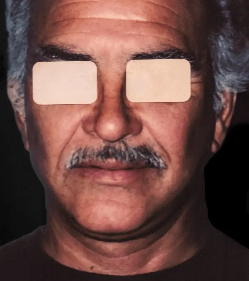 Aesthetic Surgery Center: Michael R. Macdonald, M.D. neck liposuction after — San Francisco, CA