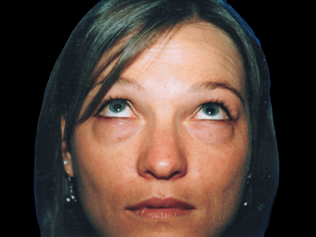 Blepharoplasty before at Aesthetic Surgery Center: Michael R. Macdonald, M.D. in San Francisco, CA