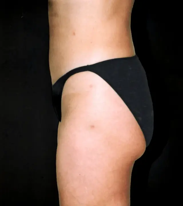 Liposuction after at Aesthetic Surgery Center: Michael R. Macdonald, M.D. in San Francisco, CA