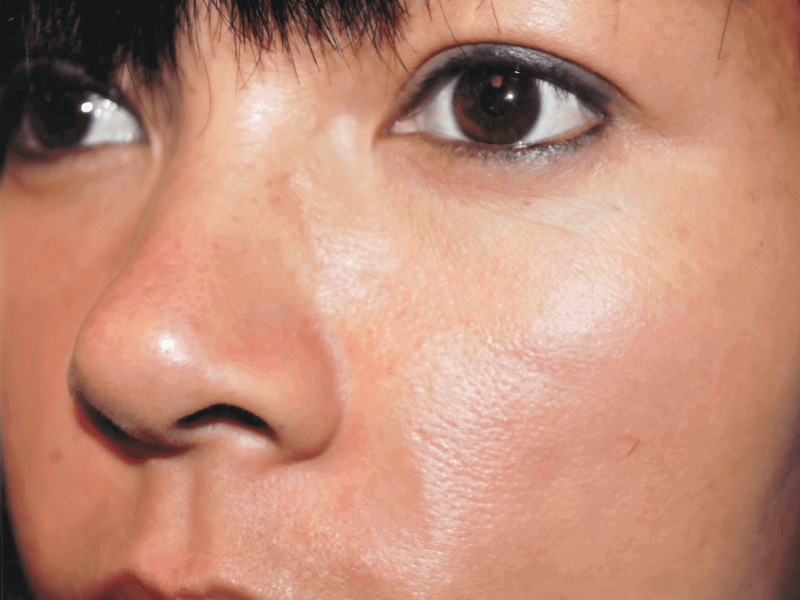 Aesthetic Surgery Center: Michael R. Macdonald, M.D. neck lift after — San Francisco, CA