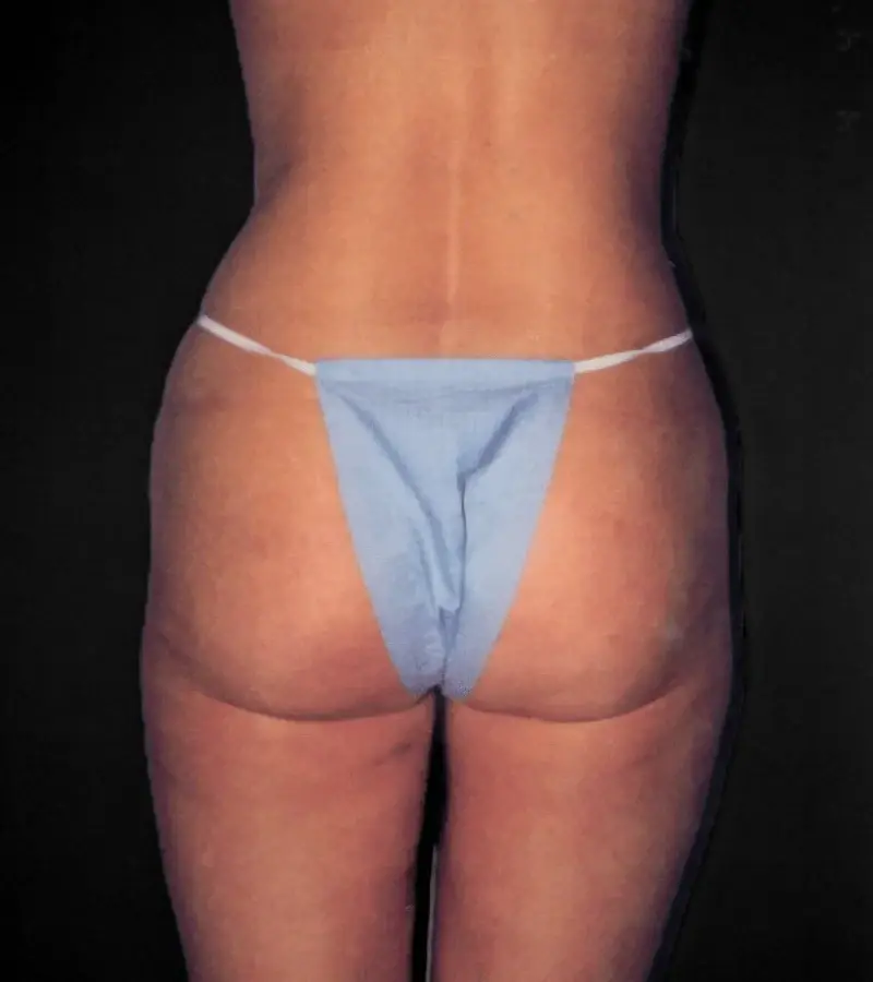 Aesthetic Surgery Center: Michael R. Macdonald, M.D. liposuction after — San Francisco, CA