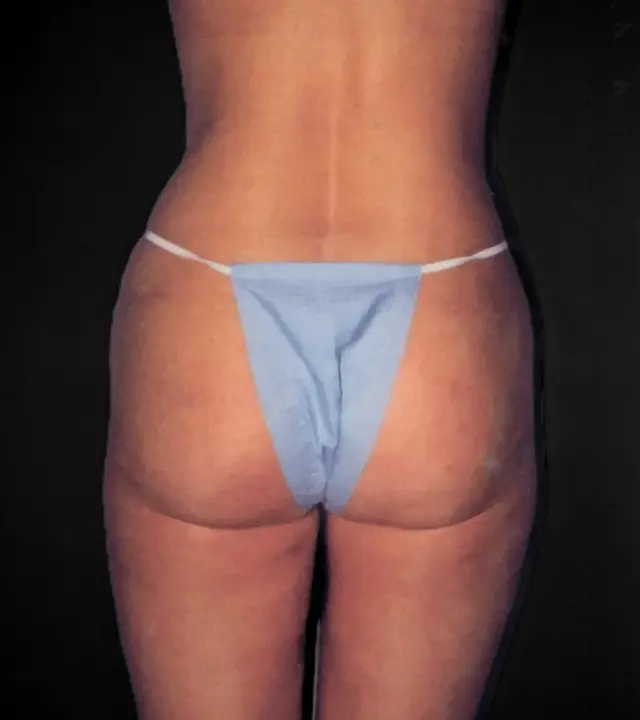 Liposuction after at Aesthetic Surgery Center: Michael R. Macdonald, M.D. in San Francisco, CA