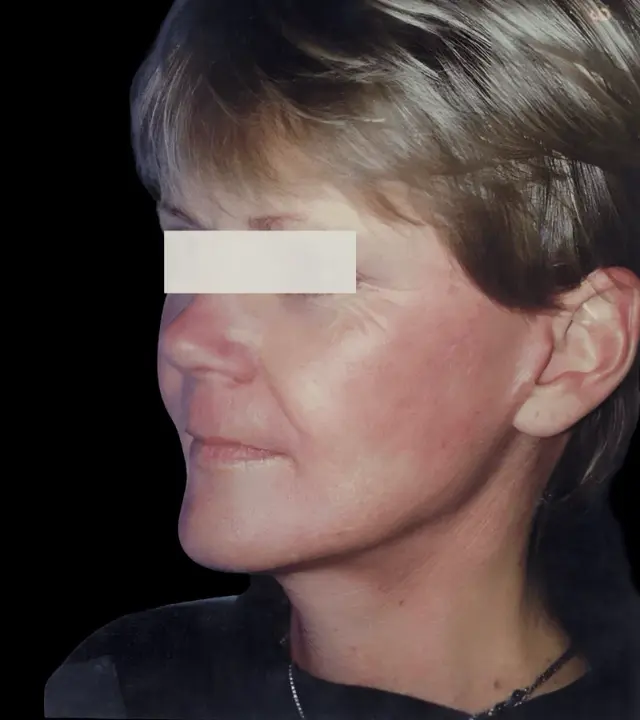Deep Plane Facelift after at Aesthetic Surgery Center: Michael R. Macdonald, M.D. in San Francisco, CA