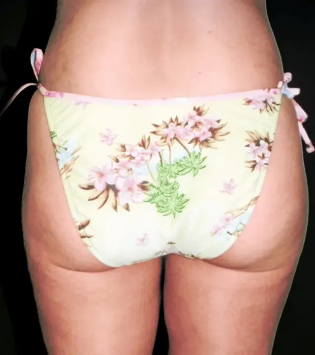 Liposuction after at Aesthetic Surgery Center: Michael R. Macdonald, M.D. in San Francisco, CA