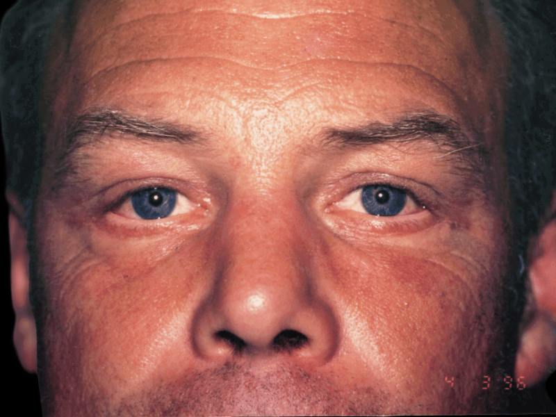 Aesthetic Surgery Center: Michael R. Macdonald, M.D. neck lift after — San Francisco, CA