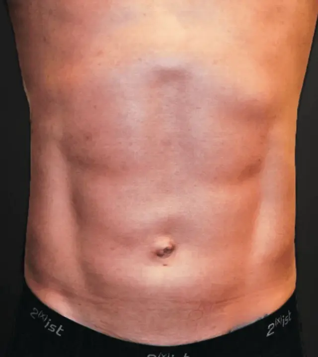 Liposuction after at Aesthetic Surgery Center: Michael R. Macdonald, M.D. in San Francisco, CA
