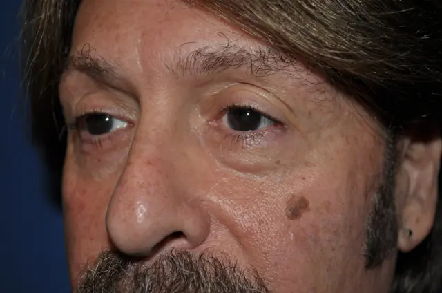 Blepharoplasty before at Aesthetic Surgery Center: Michael R. Macdonald, M.D. in San Francisco, CA