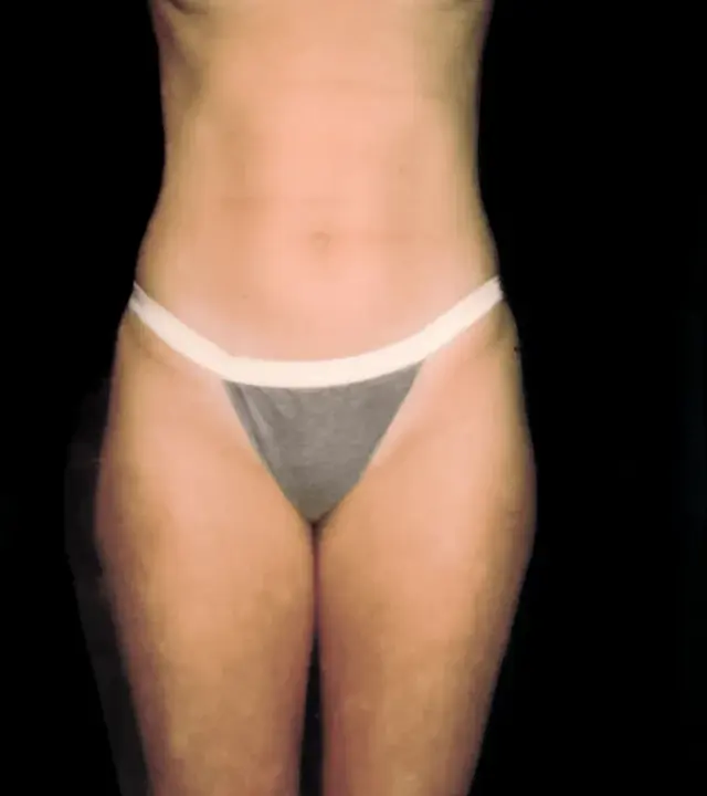Liposuction before at Aesthetic Surgery Center: Michael R. Macdonald, M.D. in San Francisco, CA