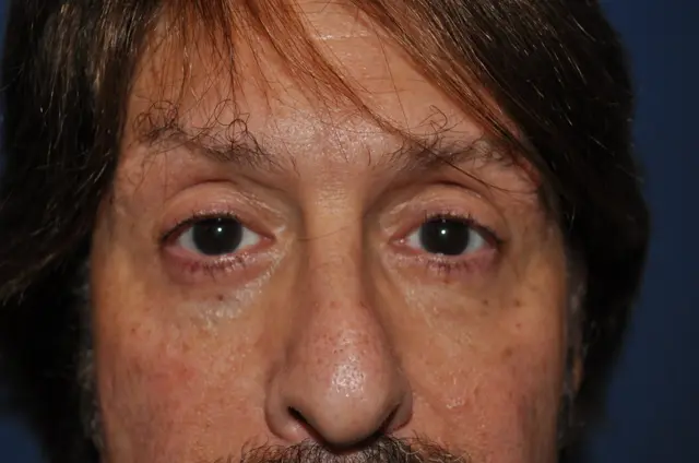 Blepharoplasty after at Aesthetic Surgery Center: Michael R. Macdonald, M.D. in San Francisco, CA