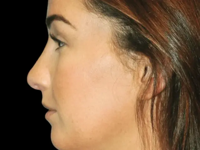 Functional Rhinoplasty after at Aesthetic Surgery Center: Michael R. Macdonald, M.D. in San Francisco, CA