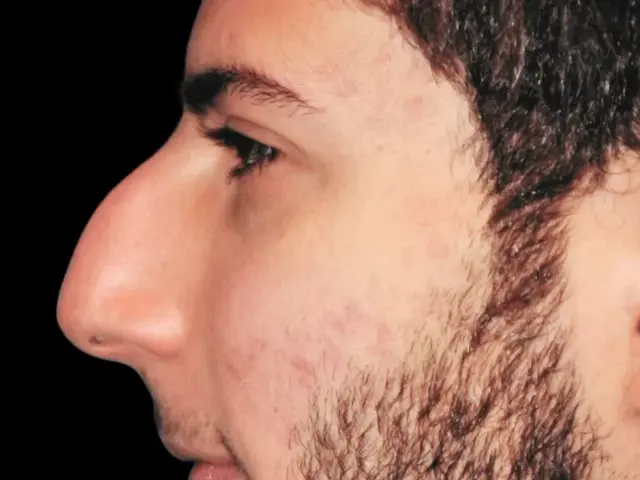 Functional Rhinoplasty before at Aesthetic Surgery Center: Michael R. Macdonald, M.D. in San Francisco, CA