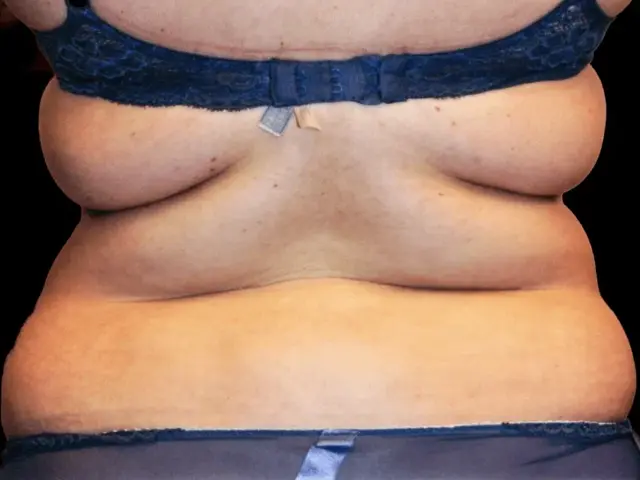 Liposuction before at Aesthetic Surgery Center: Michael R. Macdonald, M.D. in San Francisco, CA