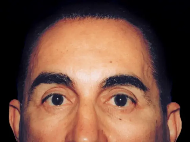 Brow Lift after at Aesthetic Surgery Center: Michael R. Macdonald, M.D. in San Francisco, CA