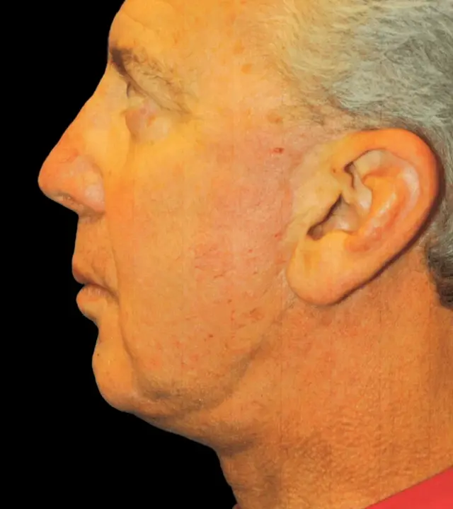 Deep Plane Facelift after at Aesthetic Surgery Center: Michael R. Macdonald, M.D. in San Francisco, CA