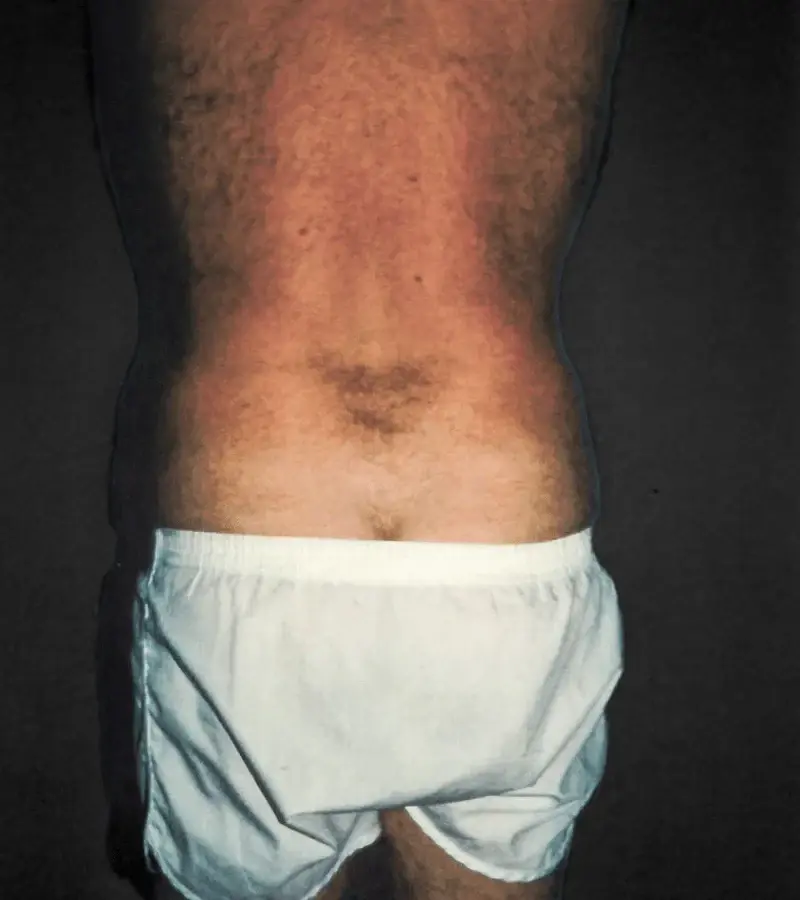 Aesthetic Surgery Center: Michael R. Macdonald, M.D. liposuction after — San Francisco, CA