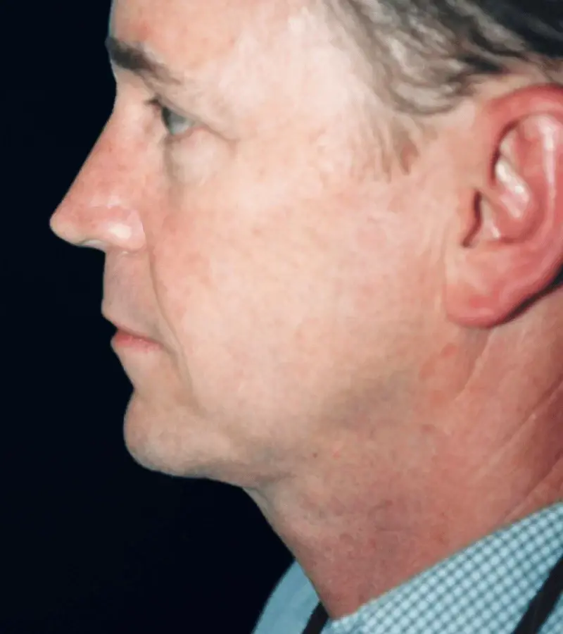 Aesthetic Surgery Center: Michael R. Macdonald, M.D. neck liposuction after — San Francisco, CA