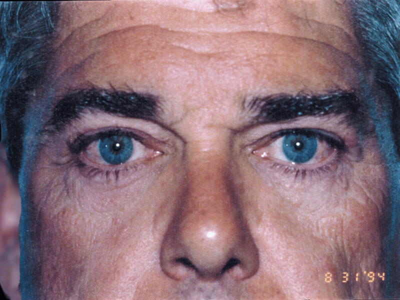 Aesthetic Surgery Center: Michael R. Macdonald, M.D. neck lift after — San Francisco, CA