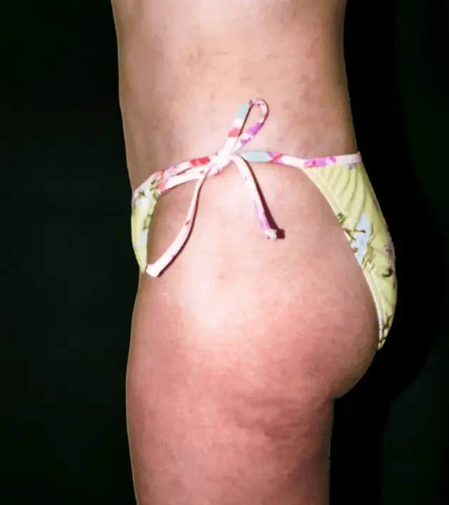 Liposuction after at Aesthetic Surgery Center: Michael R. Macdonald, M.D. in San Francisco, CA