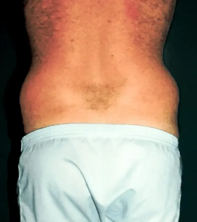 Liposuction before at Aesthetic Surgery Center: Michael R. Macdonald, M.D. in San Francisco, CA