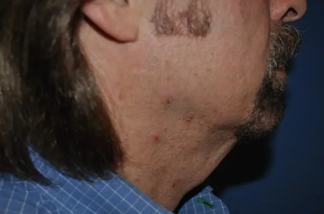 Neck Lift before at Aesthetic Surgery Center: Michael R. Macdonald, M.D. in San Francisco, CA