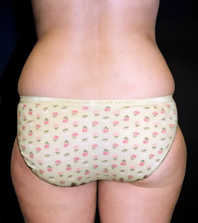 Liposuction before at Aesthetic Surgery Center: Michael R. Macdonald, M.D. in San Francisco, CA