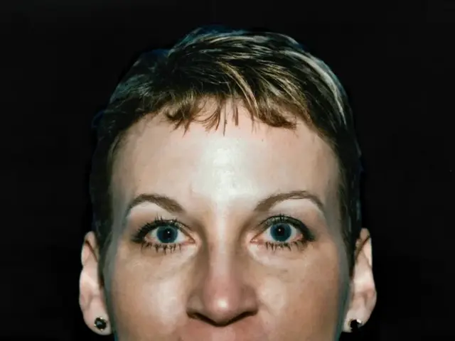 Brow Lift after at Aesthetic Surgery Center: Michael R. Macdonald, M.D. in San Francisco, CA