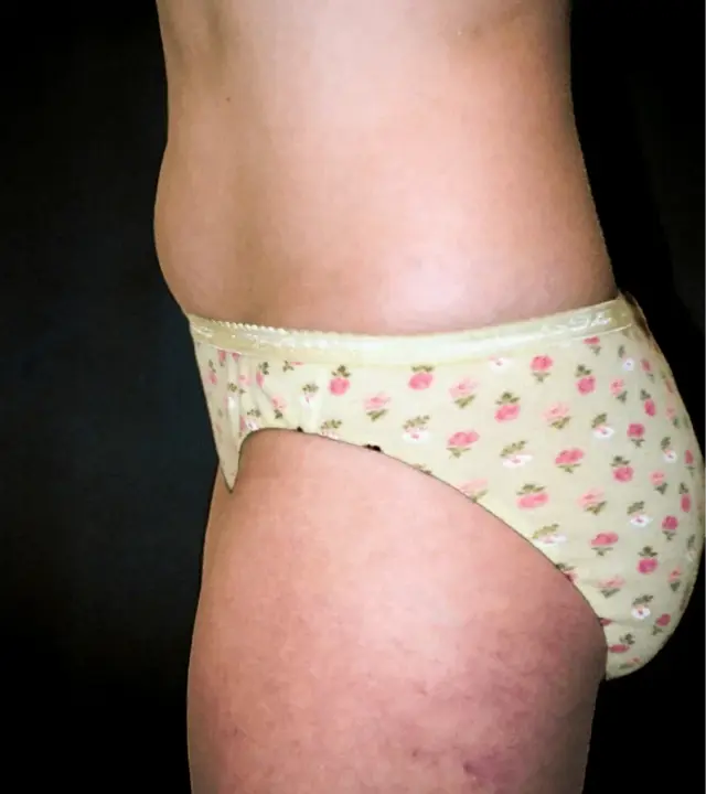 Liposuction before at Aesthetic Surgery Center: Michael R. Macdonald, M.D. in San Francisco, CA