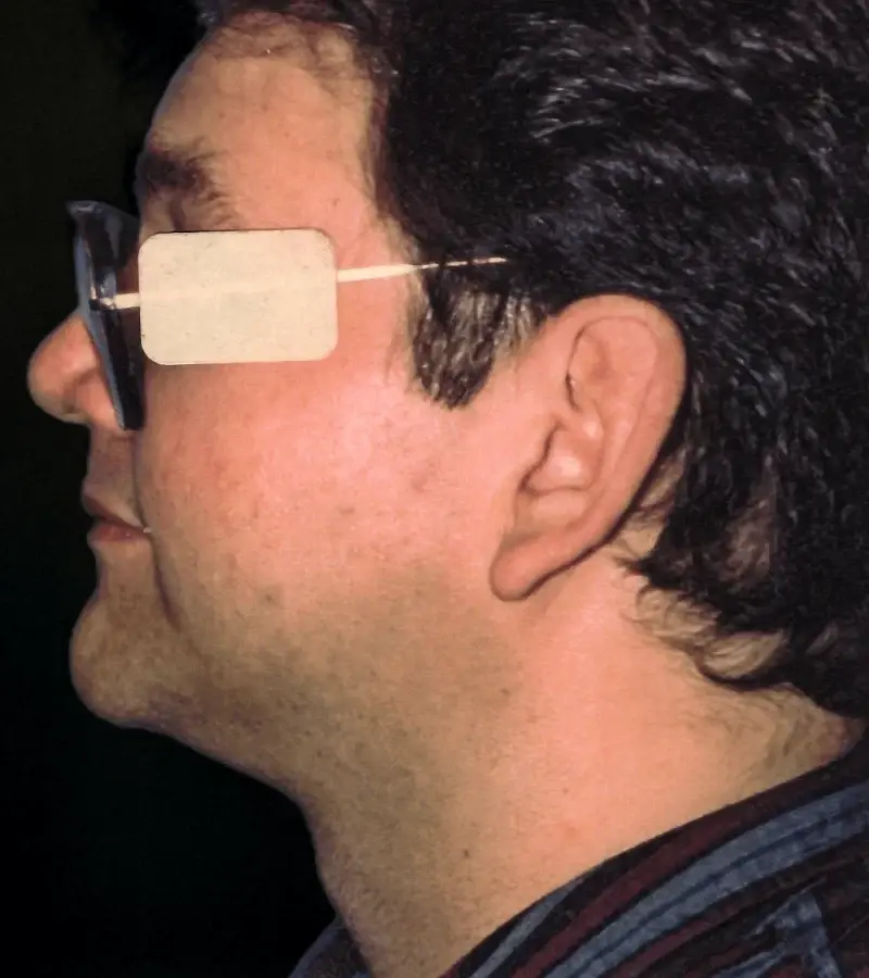 Aesthetic Surgery Center: Michael R. Macdonald, M.D. neck liposuction after — San Francisco, CA