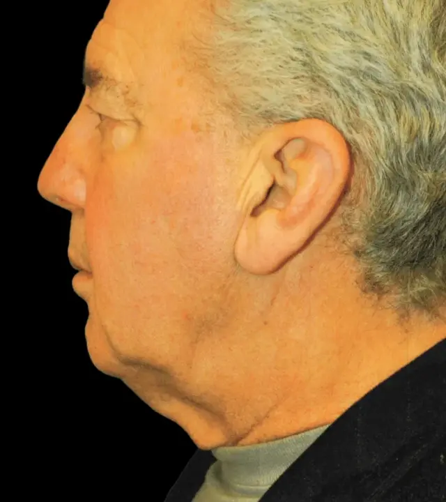 Deep Plane Facelift before at Aesthetic Surgery Center: Michael R. Macdonald, M.D. in San Francisco, CA