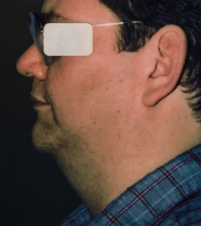 Neck Liposuction before at Aesthetic Surgery Center: Michael R. Macdonald, M.D. in San Francisco, CA